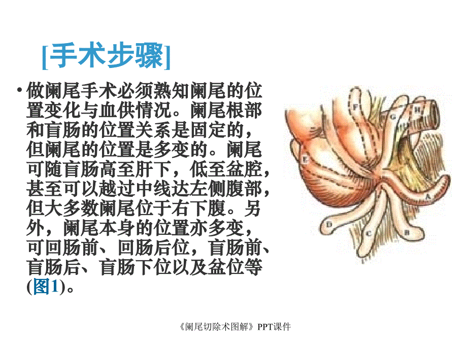 阑尾切除术图解课件_第4页