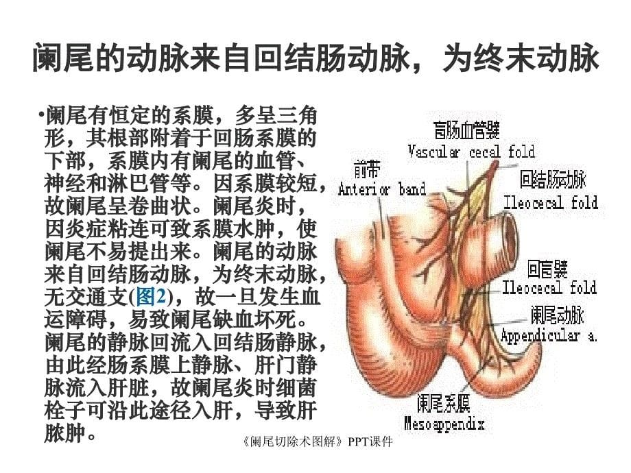 阑尾切除术图解课件_第5页