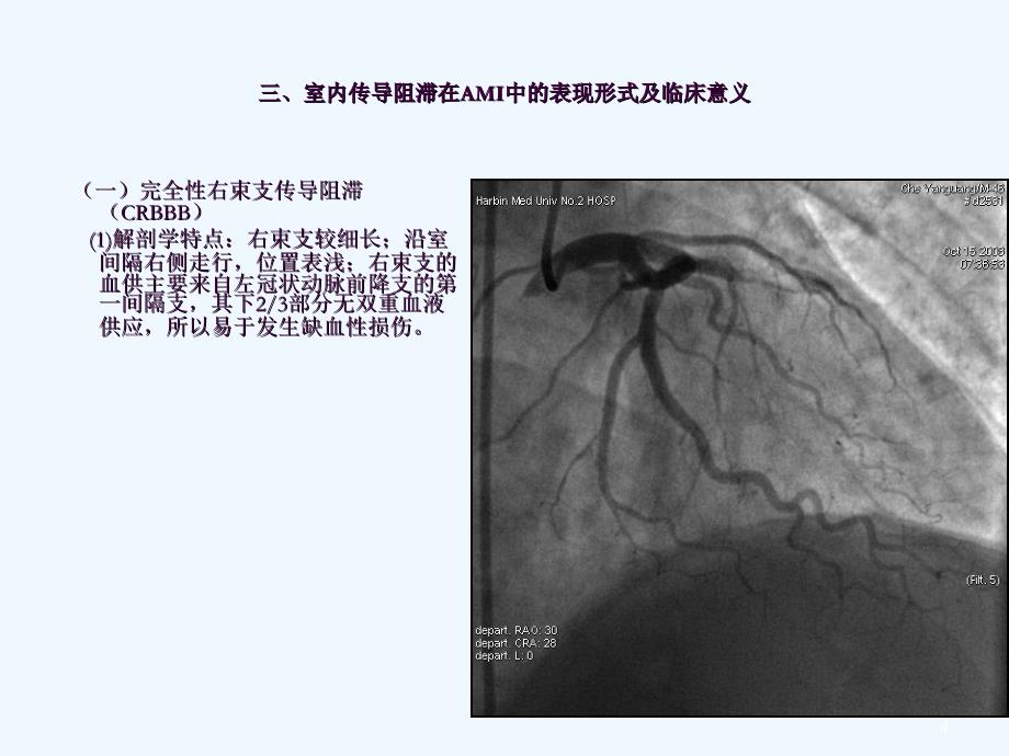 室内传导阻滞在急性心肌梗死中的临床意义及治疗原则ppt课件_第4页