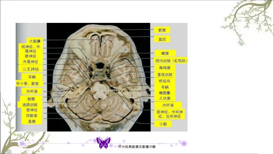 桥小脑角区病变影像诊断_第3页