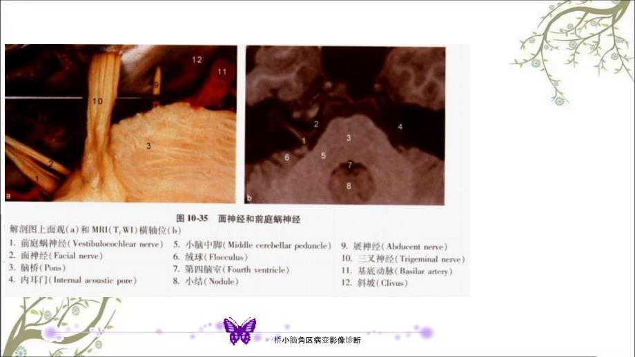 桥小脑角区病变影像诊断_第4页