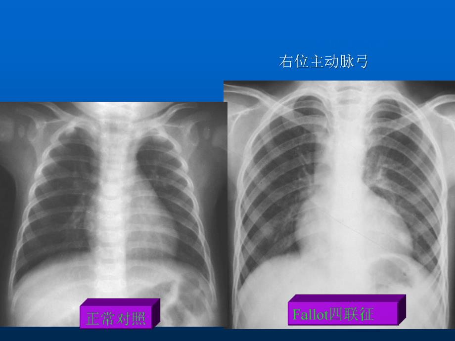 医学影像学：06-1 基本病变的X线表现主动脉形状及密度的改变_第2页