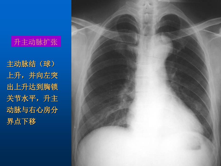 医学影像学：06-1 基本病变的X线表现主动脉形状及密度的改变_第3页