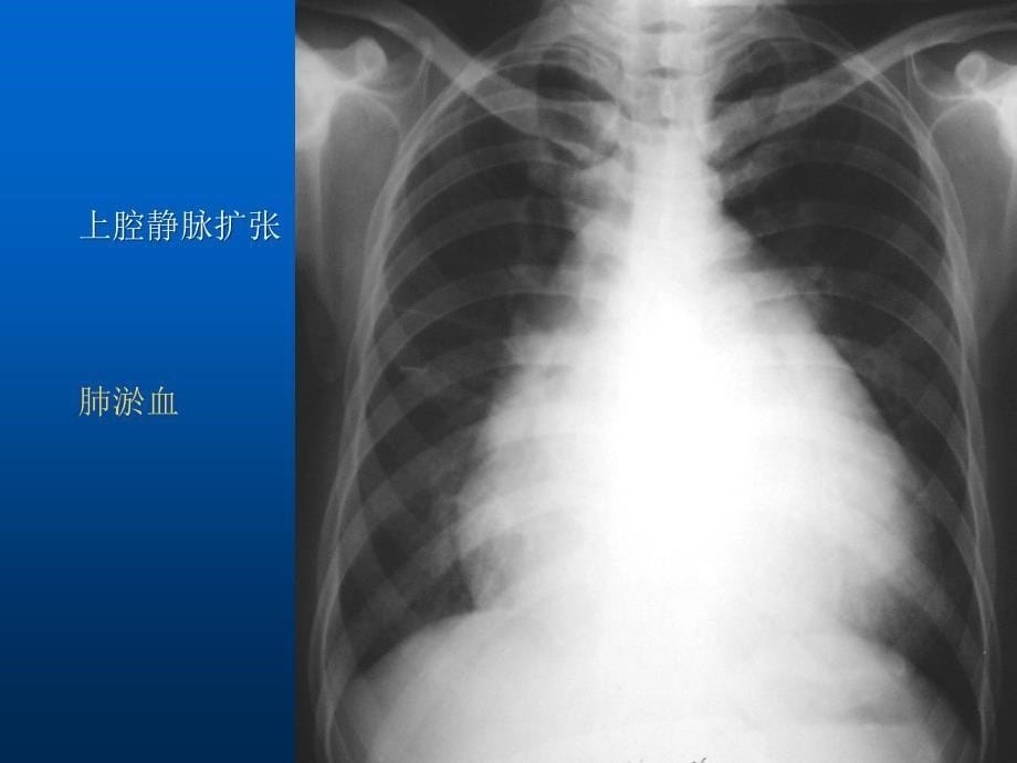 医学影像学：06-1 基本病变的X线表现主动脉形状及密度的改变_第5页