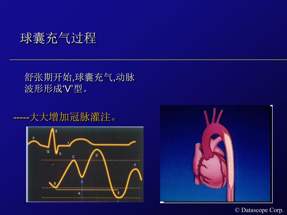 主动脉内球囊反搏泵的临床使用.ppt_第3页