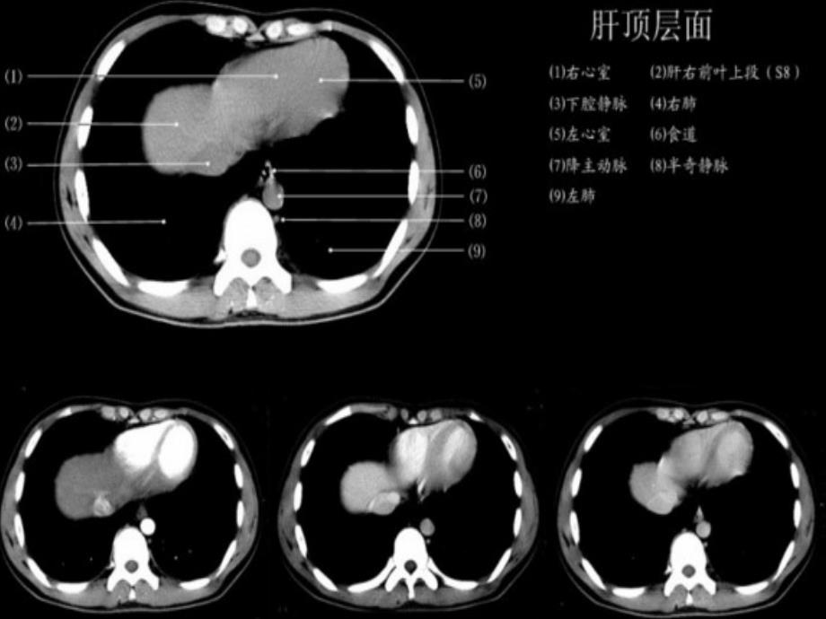 腹部断层解剖和断层CT(精品).ppt_第4页