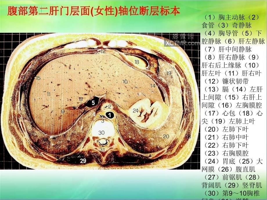 腹部断层解剖和断层CT(精品).ppt_第5页