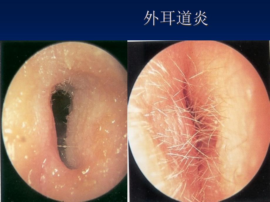 五官科护理第六章耳部常见疾病病人的护理ppt课件_第3页