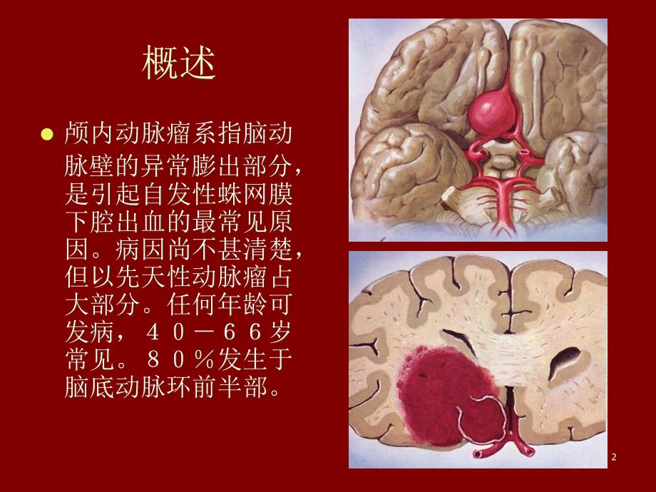 颅内动脉瘤ppt课件_第2页