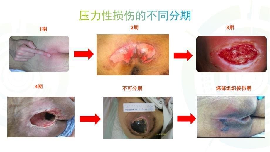 浅谈压力性损伤_第5页