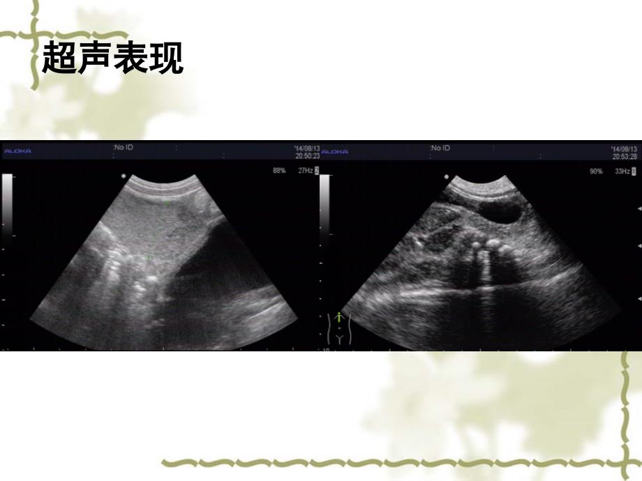 肛门闭锁的分类及超声诊断.ppt_第3页