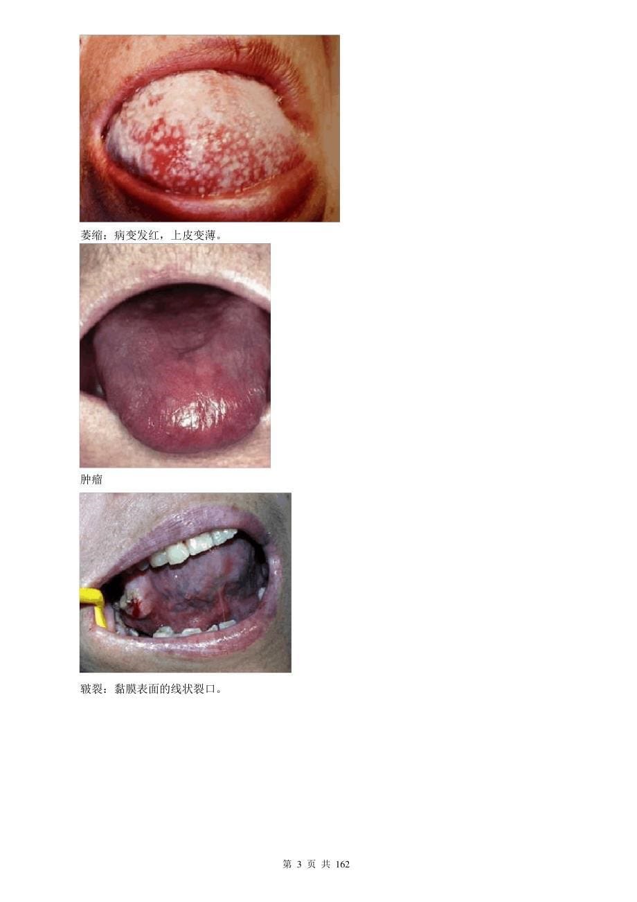 口腔内科学(口腔黏膜病牙周病等)讲义_第5页