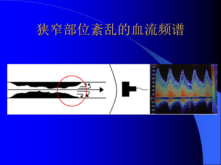 CD血流速度增快或减慢的病理生理意义_第4页