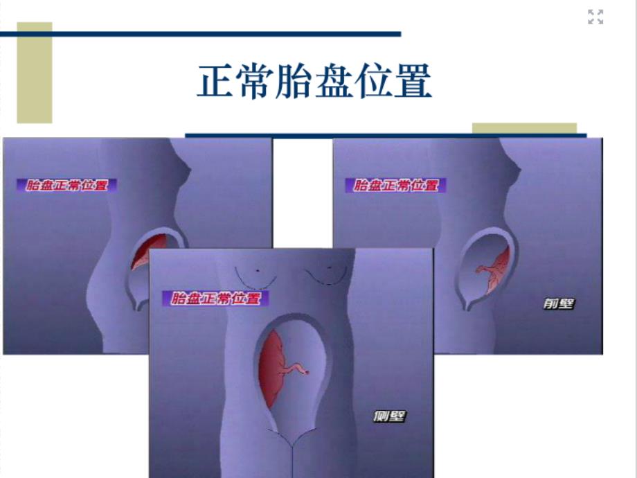 新整理前置胎盘的护理ppt课件_第2页