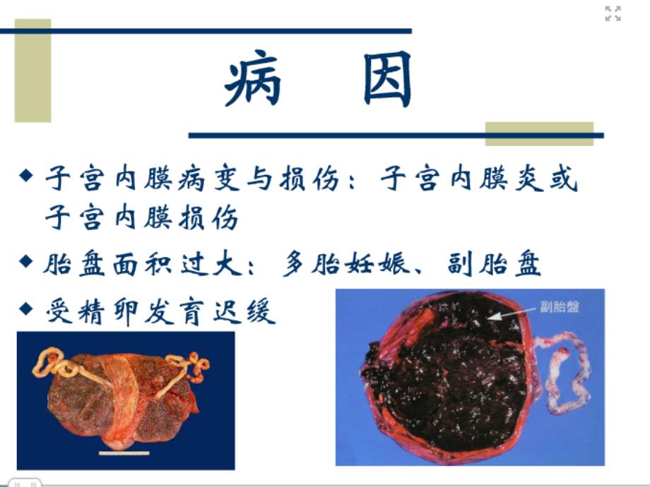 新整理前置胎盘的护理ppt课件_第4页