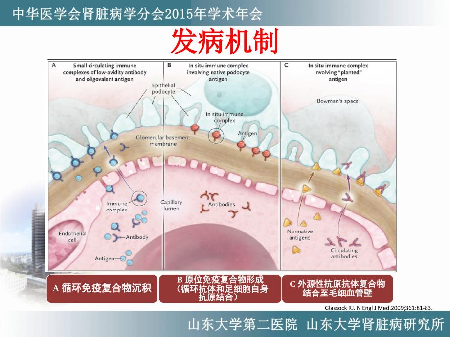 膜性肾病诊治进展_第4页