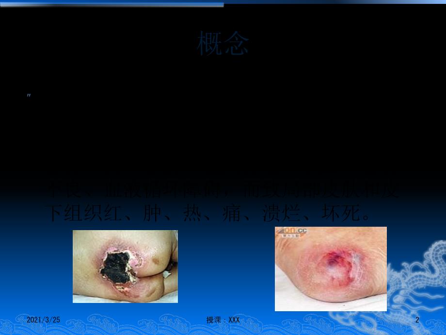 压疮病人的护理PPT课件_第2页