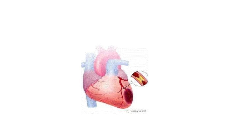 急性ST段抬高型心肌梗死溶栓治疗合理用药指南_第5页