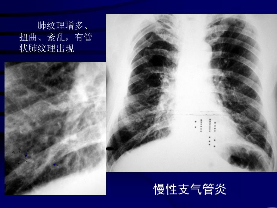 先天性支气管肺囊肿_第4页