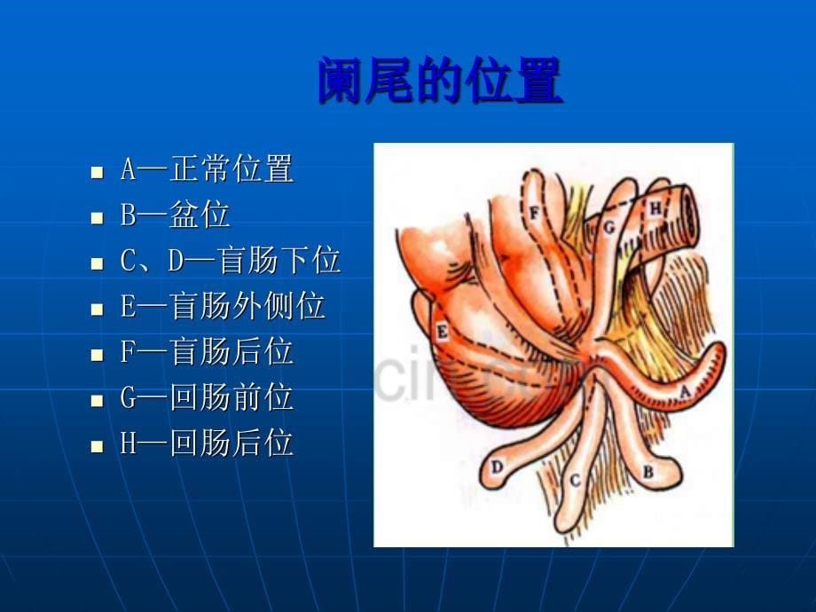 急性阑尾炎的CT诊断_第5页