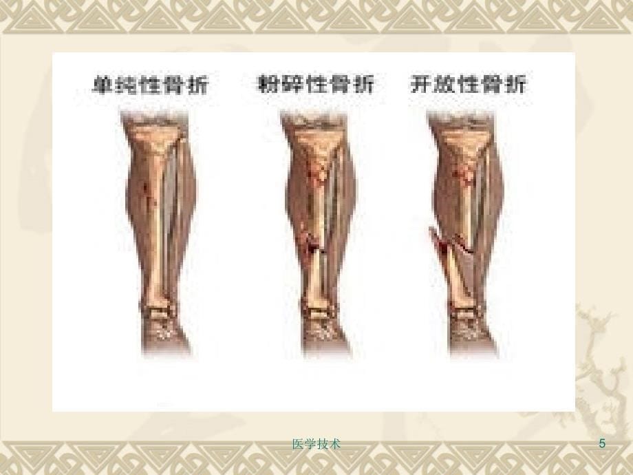 胫腓骨骨折护理医学技术_第5页