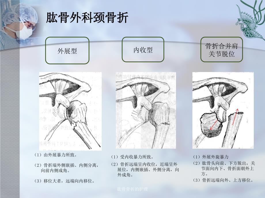 肱骨骨折的护理_第4页