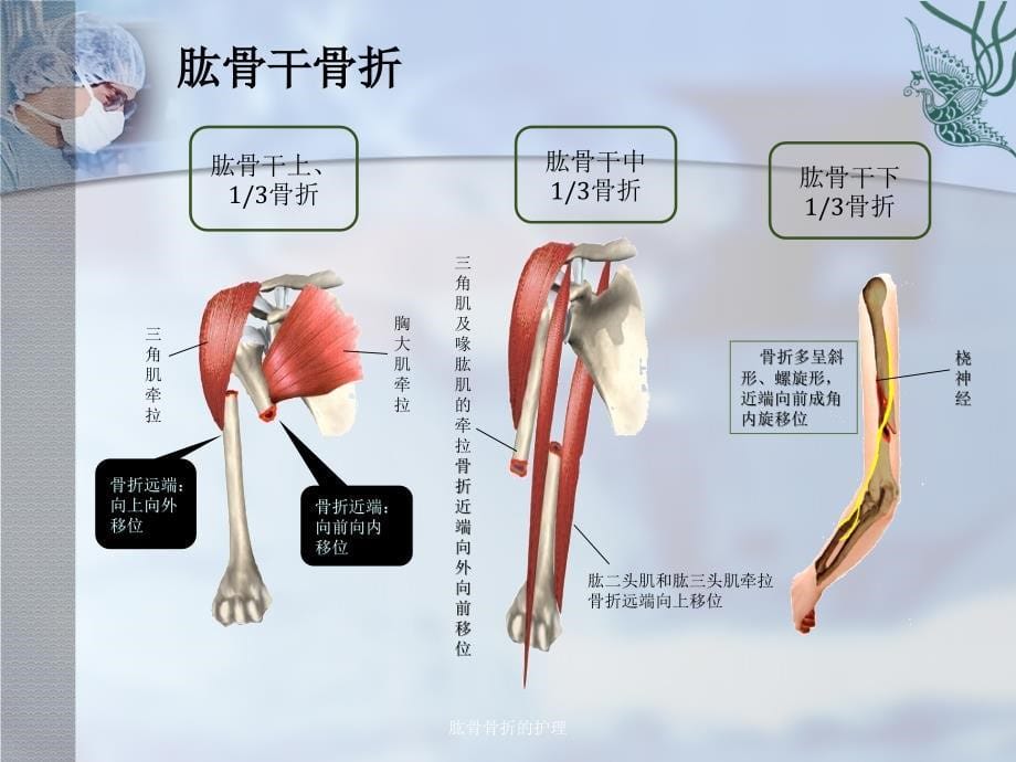 肱骨骨折的护理_第5页