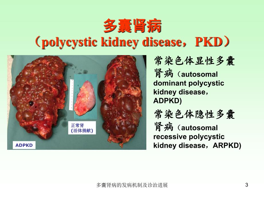 多囊肾病的发病机制及诊治进展课件_第3页