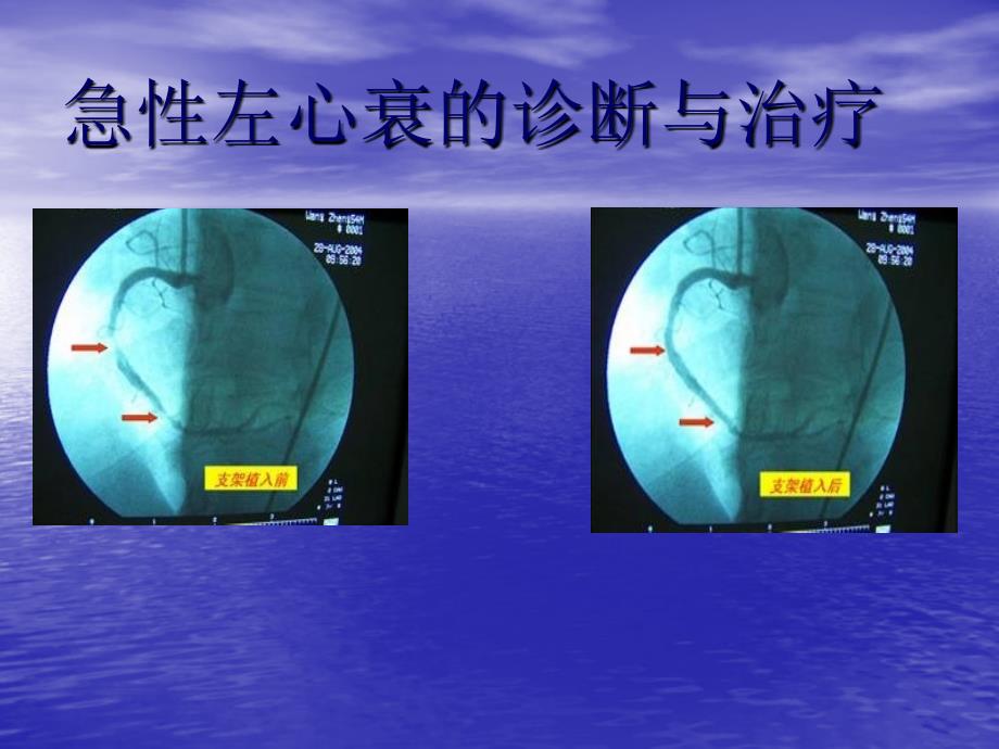 急性左心衰课件_第1页