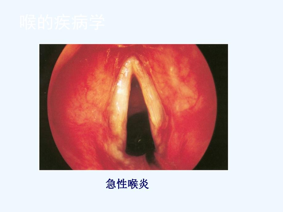 喉的良性病变与喉癌图谱课件_第1页