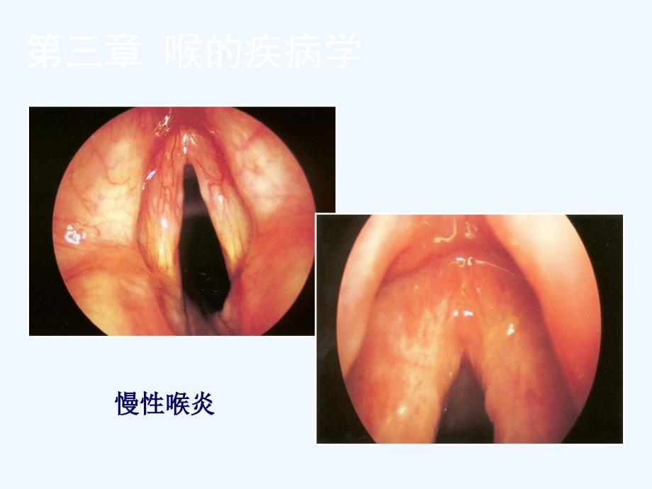 喉的良性病变与喉癌图谱课件_第2页