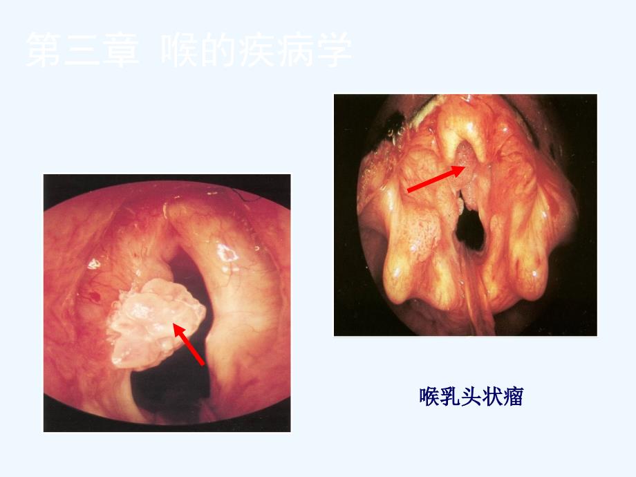 喉的良性病变与喉癌图谱课件_第3页