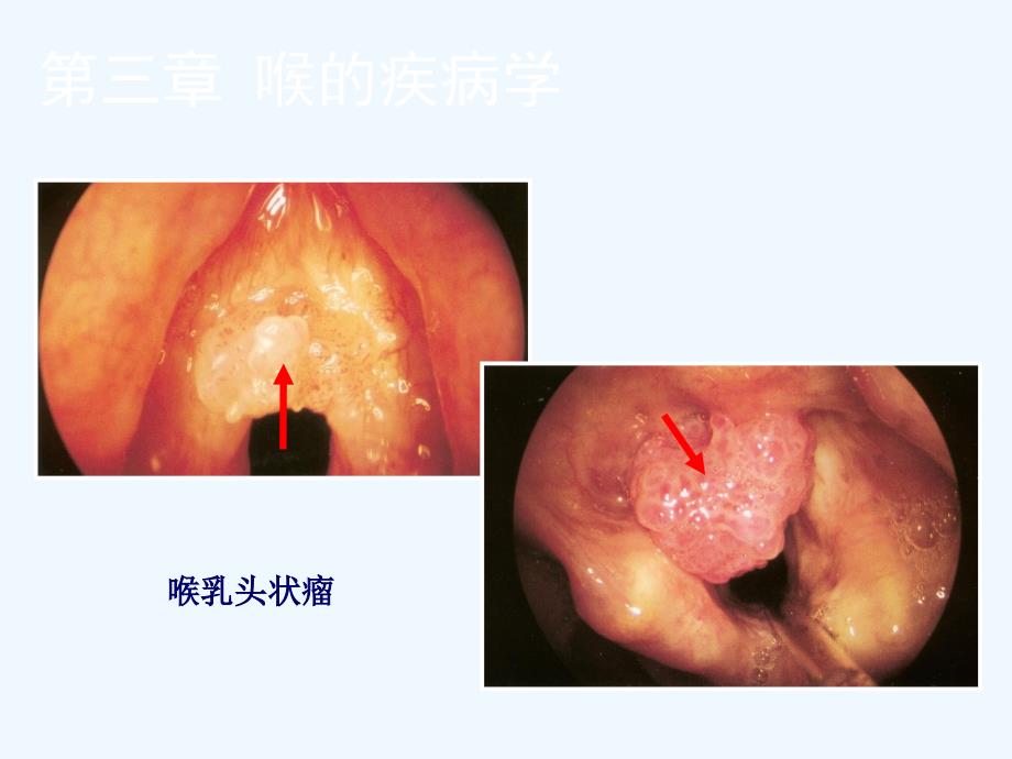 喉的良性病变与喉癌图谱课件_第4页