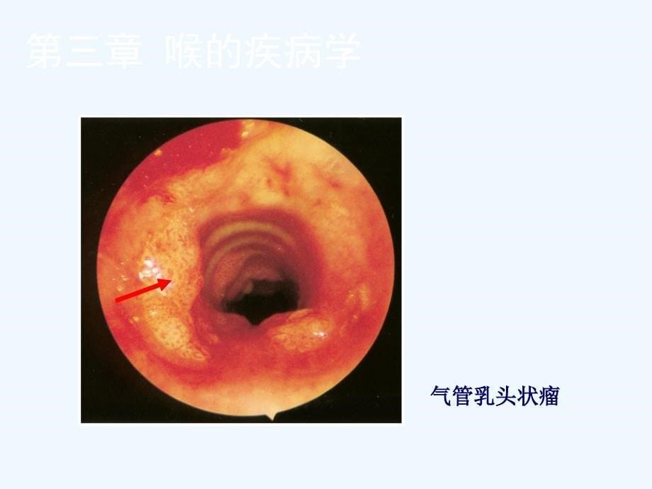 喉的良性病变与喉癌图谱课件_第5页