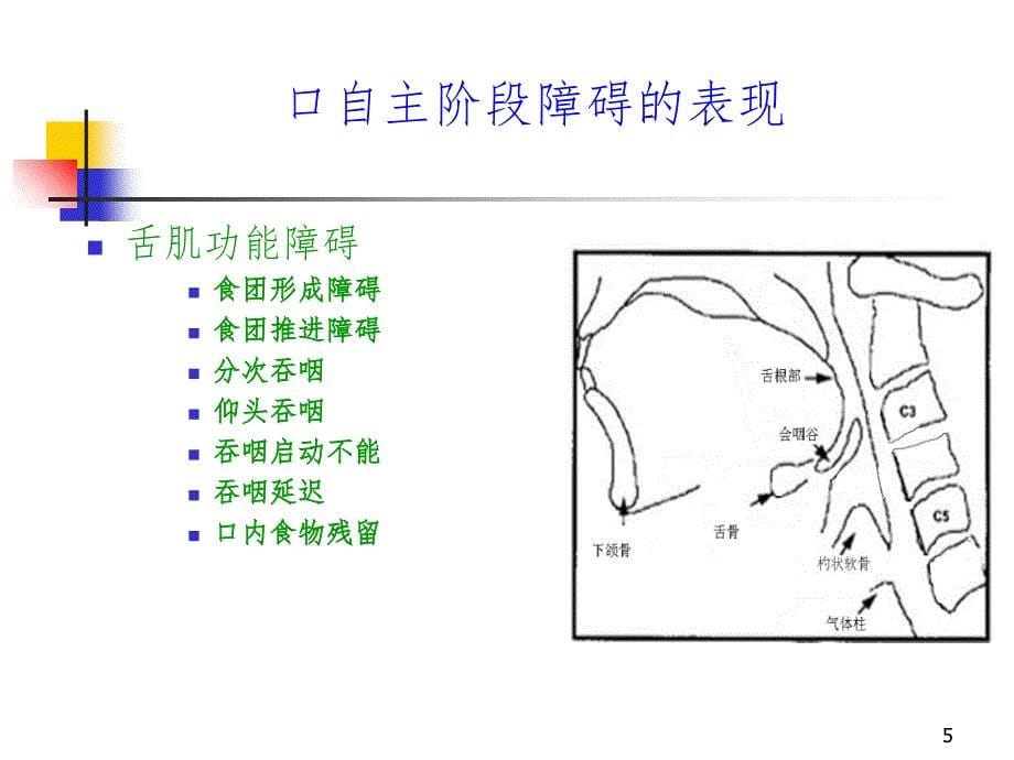 脑卒中后吞咽困难PPT课件_第5页