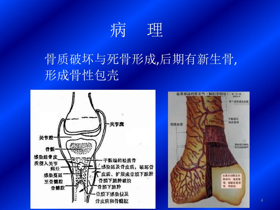 (医学课件)骨与关节感染最新ppt演示课件_第4页