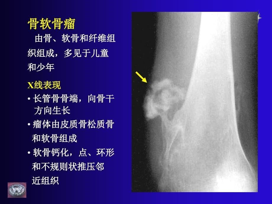 骨肿瘤CT和MRI的影像表现_第5页