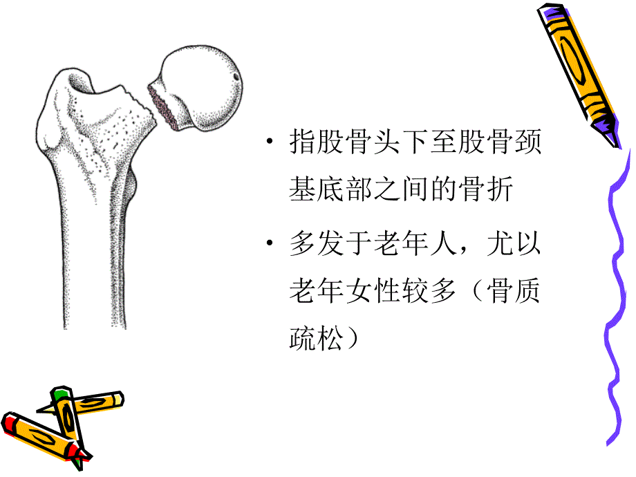 股骨颈骨折的护理.ppt_第3页