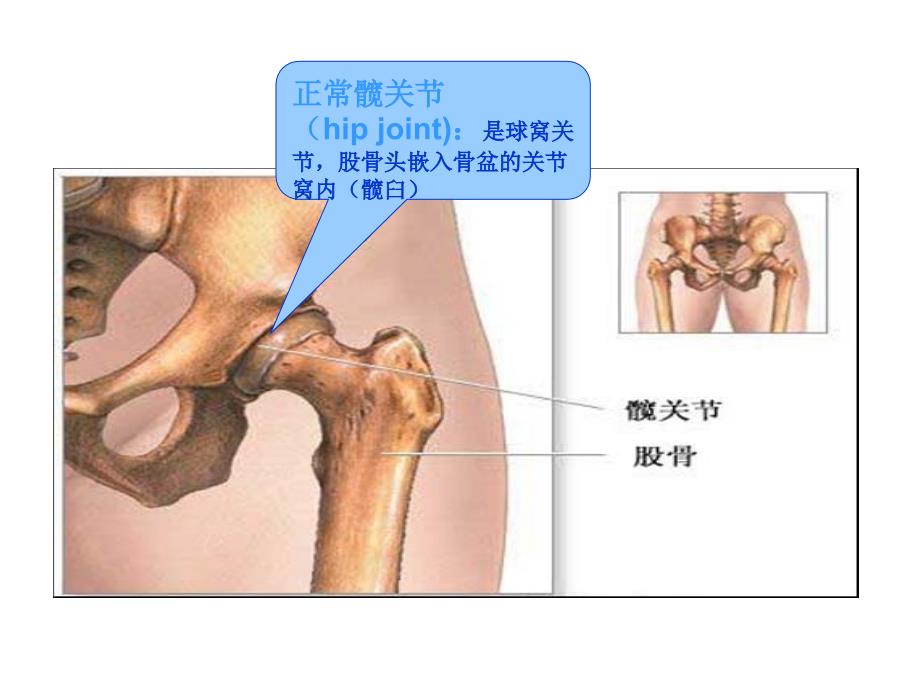 股骨颈骨折的护理.ppt_第4页