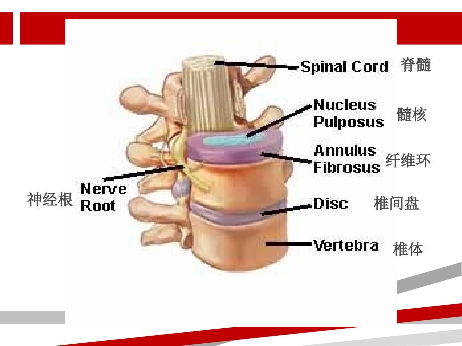 腰椎间盘突出症病人的护理课件_第3页