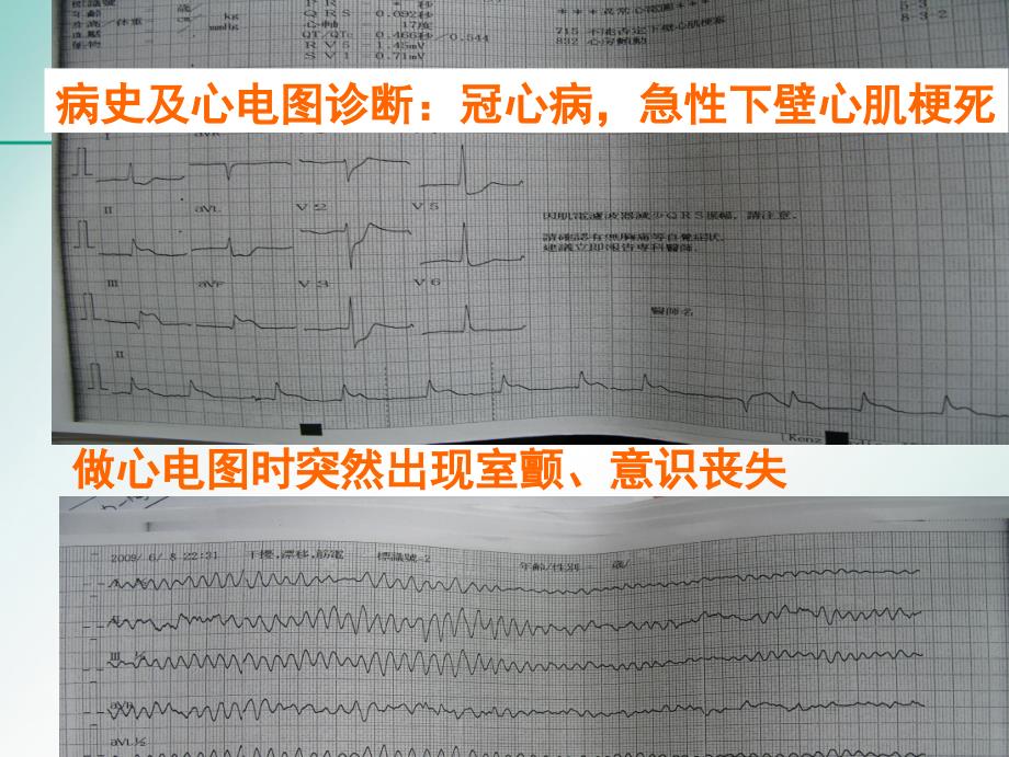 心肌梗死防治教刘洪智ppt课件_第3页