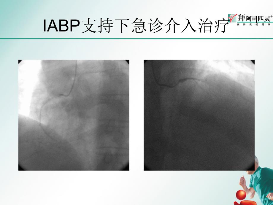 心肌梗死防治教刘洪智ppt课件_第4页