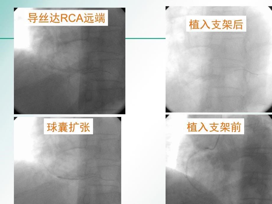 心肌梗死防治教刘洪智ppt课件_第5页