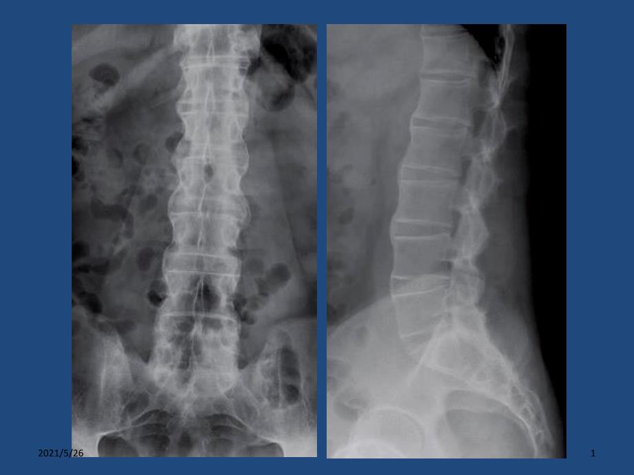 强直性脊柱炎AnkylosingSpondylitisASPPT优秀课件_第1页