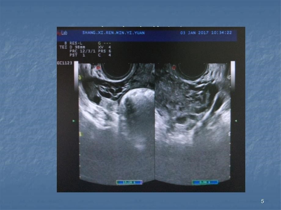 子宫动静脉瘘超声诊断ppt课件_第5页