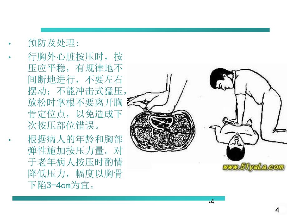 胸外心脏按压操作并发症及处理PPT参考幻灯片_第4页