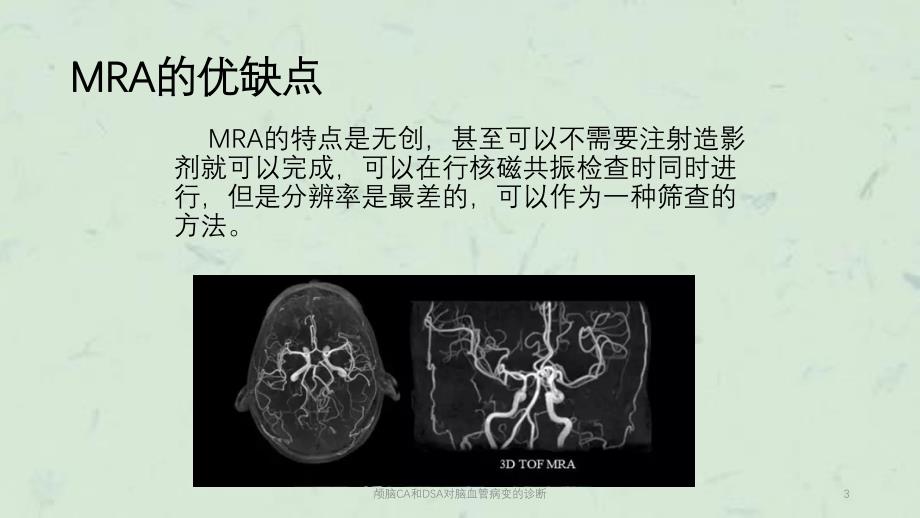 颅脑CA和DSA对脑血管病变的诊断课件_第3页