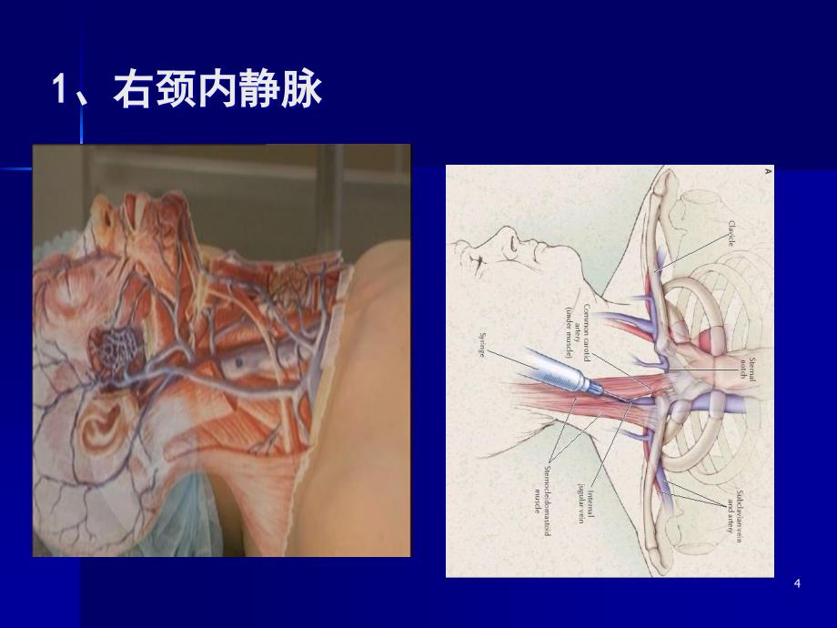 深静脉置管术ppt课件_第4页