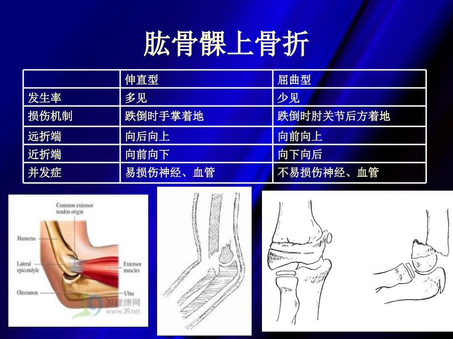 《肱骨髁上骨折》PPT课件_第2页