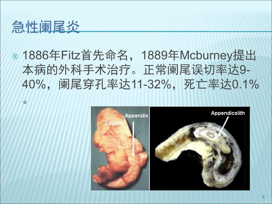 阑尾炎专题讲座.PPT_第4页